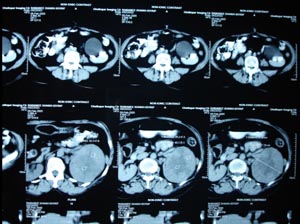 Renal cell carcinoma 1